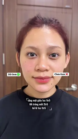 Đưa các nàng xem kết quả thực tế, nhẹ nhàng nhưng khác biệt rõ ràng. #dmanh #filler #botox #CapCut 