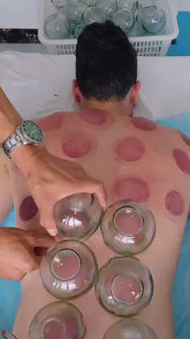 ASMR: Chinese Uncle Gives Me an Insane Strong Chinese Back Massage and Fire Cupping 🎥 Watch the Full Video on my Channel! ⭐ Follow for more content like this! #asmr #massage #cuppingtherapy #chinesemassage #chinesecupping #asmrsleep #asmrnotalking #firecupping #asmrsound