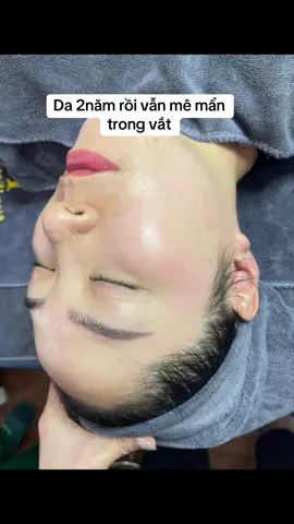 2năm rồi mà tàn nhang cứ trong vắt ý😛😛.đtri nám khoẻ ntn ai mê k .Chủ spa nào cần phac đồ ib P na#nám #maketing #mụn #kinhdoanhspa 
