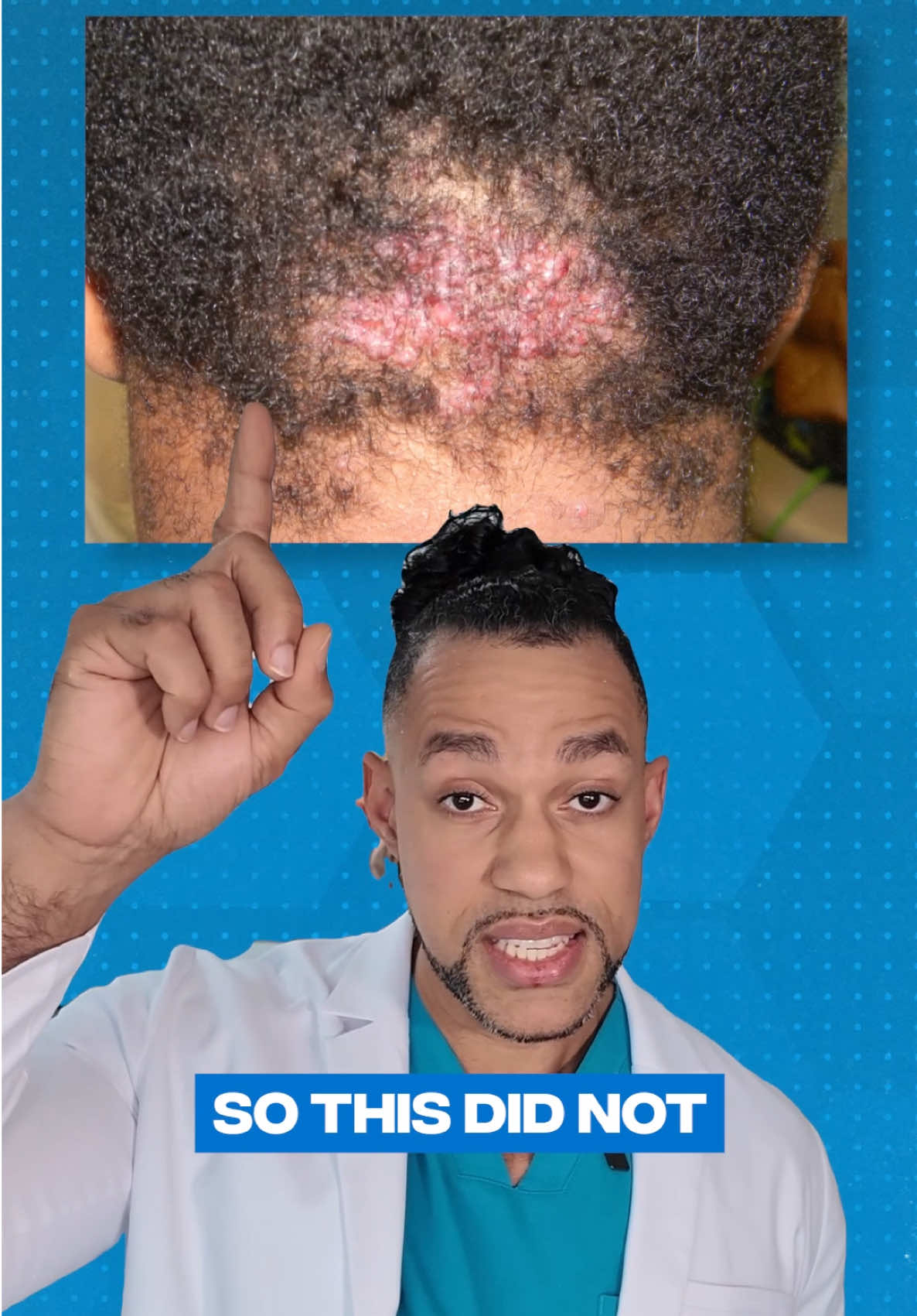 Acne Keloodalis Nuchae. Not because of dirty clippers 👀