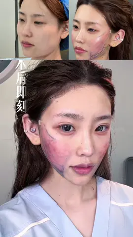 From Overfilled to Refined ✨ Too much filler once left her face heavy and swollen. With Dr. Xie’s 9D Facelift, the puffiness is gone—her face is now light, defined, and beautifully natural. 💫 #9DFacelift #FacialRefinement #NaturalAesthetics #AntiAging #FacialContour #YouthfulGlow