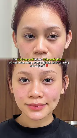 Cận cảnh một ca trũng mắt tầng mặt giữa, hố lê cho bé khách dễ thưn ngày hôm nay. GATO sẽ bảo chỉnh app 😡 #dmanh #filler #botox #CapCut 