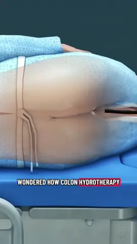 How Is Colon Hydrotherapy Performed( (3D Animation) #colonhydrotherapy #intestinalirrigation #intestinecleaning #coloncleansed #bowel #medical3danimation #3dmedicalanimation 