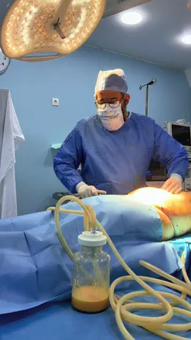 #liposuccion #liposuction #شفط_الدهون #lipofilling #زرع_الدهون 