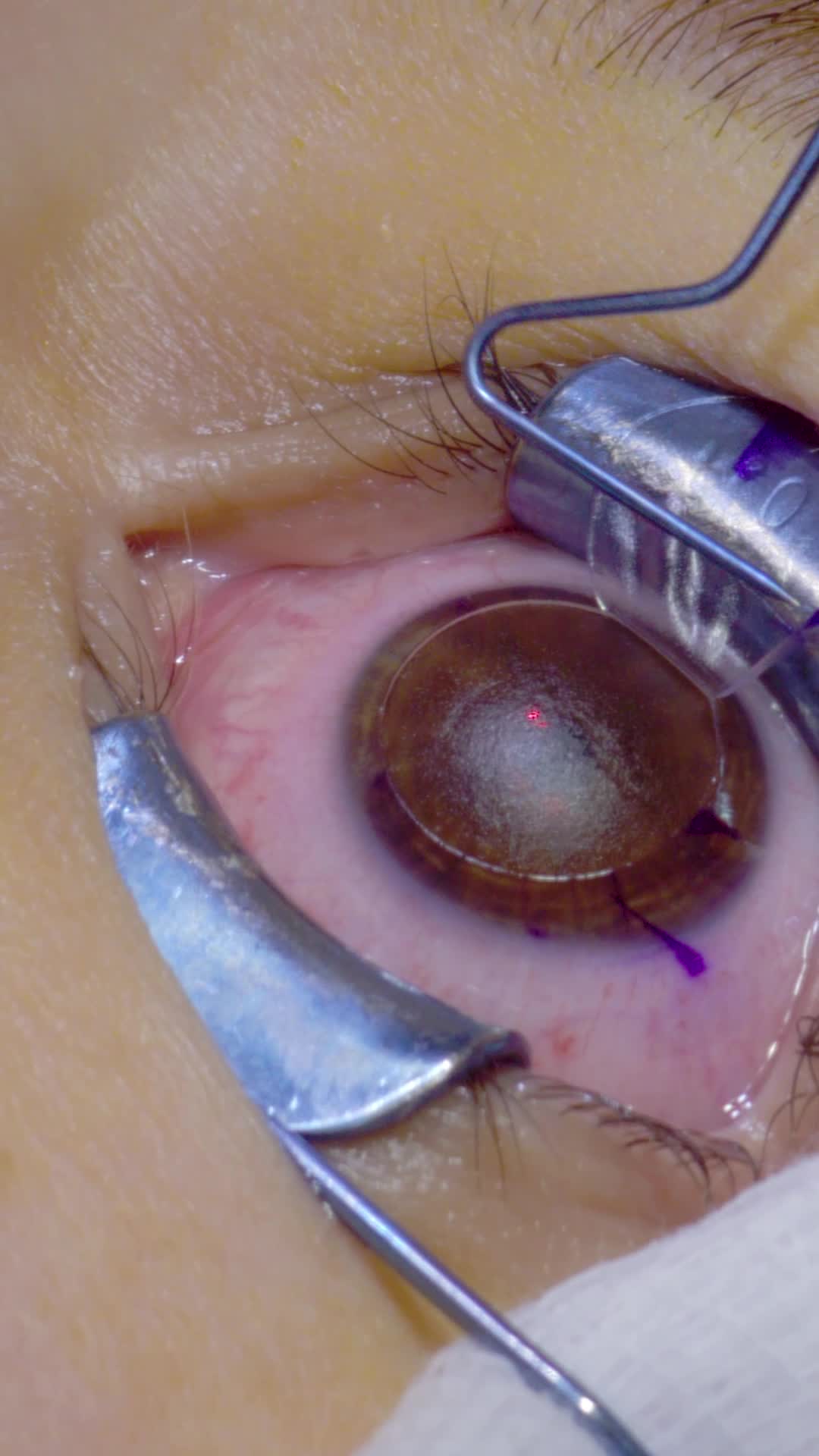 Tchau, miopia! #lasik #refractivesurgery #myopia #cirurgiarefrativa #cirurgiademiopia #eyedetail #eye #macro #ophtalmology #drtiagocesar