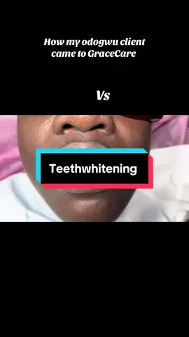 He came with yellow teeth and left with white teeth 😄😄#gracecare #fyppppppppppppppppppppppp #fup #goviral #teethwhitening 