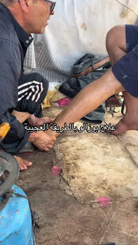 علاج  بوزالوم بالطريقة التقليدية العجيبة المغرب#اكادير_تيزنيت_تافروت_إمازيغن #المغرب🇲🇦تونس🇹🇳الجزائر🇩🇿 بطا #فرنسا🇨🇵_بلجيكا🇧🇪_المانيا🇩🇪_اسبانيا🇪🇸 #دواء#الطب العربي 