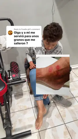 Replying to @Foodie girl  a mí mami le sirvio para estás ronchitas pero no olviden consultar con un médico. Y como siempre los resultados pueden variar. #Psoriasis #Eczema #SensitiveSkin #Rash #EczemaCream 