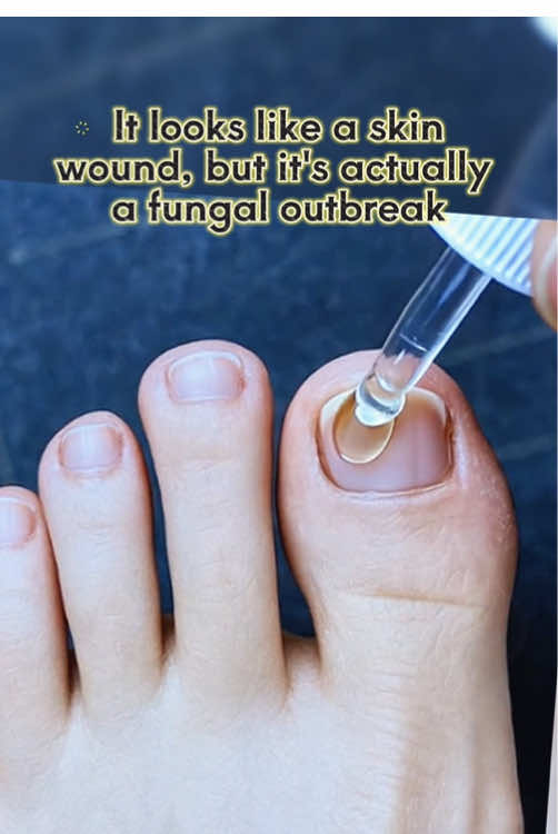 If you are in this situation, you can try this method!#nailcare #laborday #laborday2025 #toenails #gainknowledge 