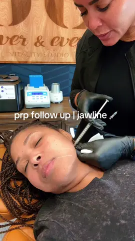 PRP injections - round 3 at Ever & Ever Vitality Studio in Mooresville, NC ✨ 💉 #prp #prpinjections #facialinjections #biofiller