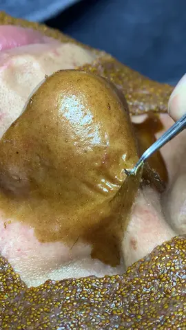 Chiến#chamsocdamun#chamsocdanam#chamsocdaseo#lequynhspa#hocnghespa 