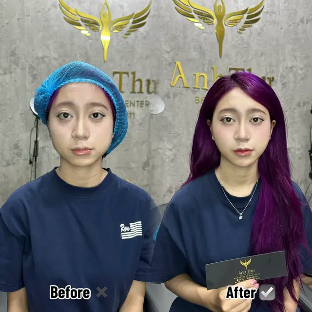 #anhthubeautycenter #anhthuyummy #fillerbotox #fullface 