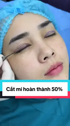 Cắt mí cho em khách hàng mắt sụp do da chùng #catmi #suami #nhanmi #pttm #ilovetiktok 
