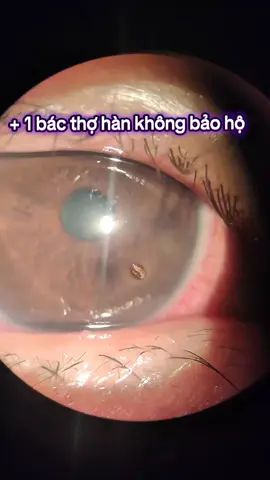 Dị vật mạt sắt #suckhoemat #bstancuong #bacsimatvinhphuc #LearnOnTikTok 