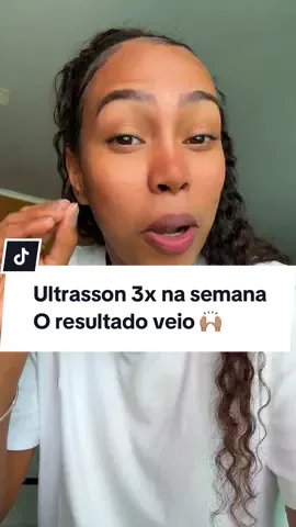 Faço 3x na semana e o resultado aconteceu , quase não esquenta tanto como antes 🙌🏽🙌🏽 #fisioterapia #fibrose #joelho #patela #recuperacaocirurgica 