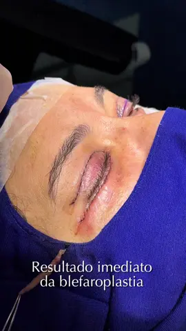 #blefaroplastia #palpebras #citurgia 