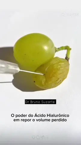 🍇 A uva murcha representa bem o que acontece com a nossa face ao longo dos anos: perda de colágeno, gordura e sustentação estrutural. O resultado? Aspecto mais cansado, flacidez e perda de contornos. Quando injetamos ácido hialurônico, devolvemos o volume estrutural perdido, reidratamos os tecidos e resgatamos a forma natural, assim como acontece com a uva que volta ao seu formato original. ✨ Essa é a lógica dos preenchimentos faciais: não se trata apenas de estética, mas de devolver sustentação, equilíbrio e jovialidade com naturalidade. 👨🏻‍⚕️ Dr Bruno Suzarte Especialista e Professor em Harmonização Orofacial CRO RJ 38496 #preenchimentofacial #harmonizacaoorofacial #acidohialuronico #rejuvenescimentofacial #esteticafacial   