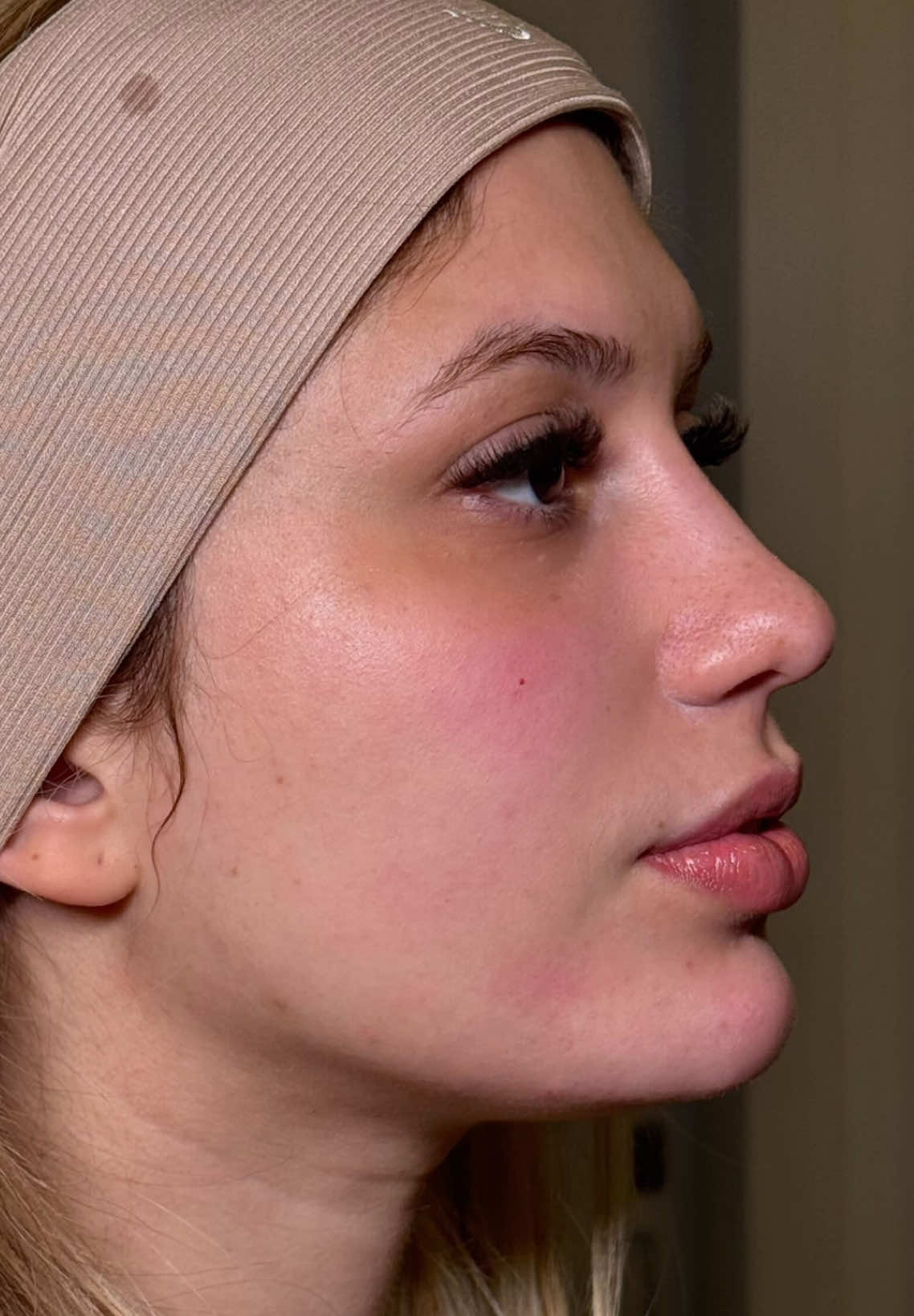 Ela se incomodava com o rosto redondo e olha só o resultado que alcançamos 😍 #harmonizacaofacialsp #saopaulo #fyp #tatuape #harmonizaçãofacial 