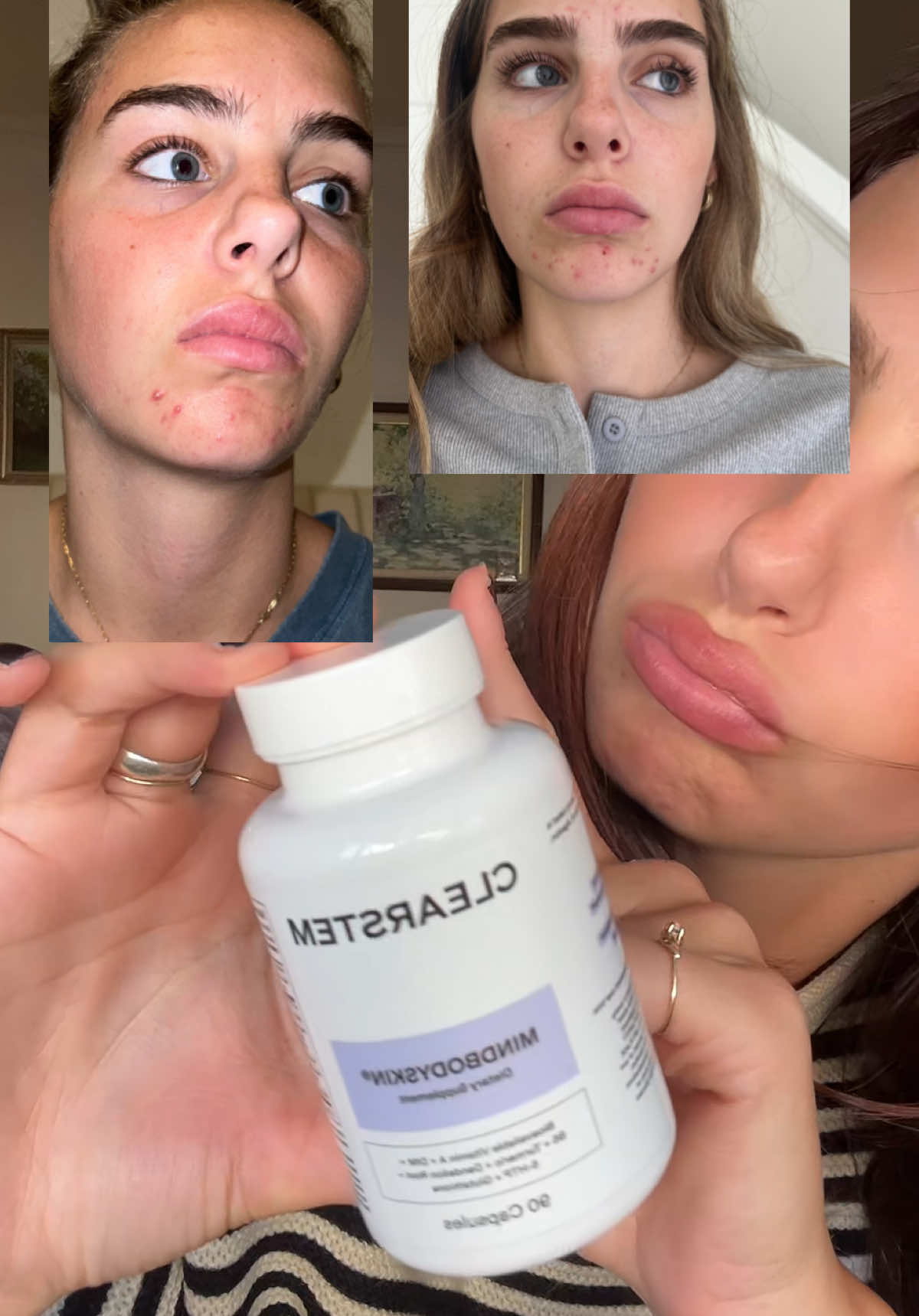 100% honest review… #mindbodyskin #clearstemskincare #clearstemhormonalacnesupplement #acne #acnesupplements 