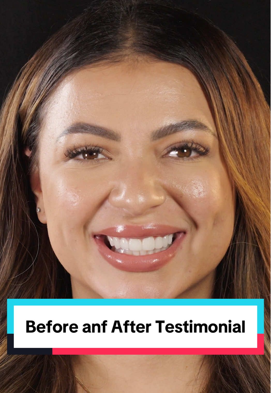 Before and After Testimonial ✨ #BeforeandAfter #NoPrepVeneers #SmileTransformation #CosmeticDentistry #AustinCosmetic 