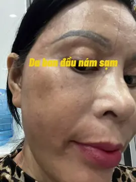 Nám tráng gương 7 ngày hút sạch nám tàn nhan nuôi da căng bóng#dalieuphuongthuy #xuhuong  #nam #mụn #tàn_nhan  #làmđẹp 