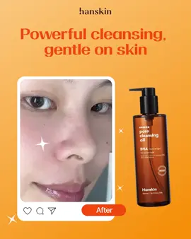 🖤 Struggling with blackheads? Your pores need detox too! Meet the Hanskin BHA Pore Cleansing Oil – powerful enough to melt away blackheads & makeup, yet gentle on your skin. ✨ Watch your pores go from clogged ➝ clean & clear. 🌿 Now’s the time to try it Amazon Best Deal 25% OFF (limited time only!) #hanskin #porecleansingoil #skincare #cleansingoil #kbeauty     