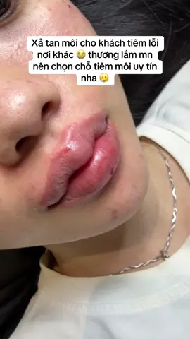 Sửa chữa lỗi lầm nơi khác 🥹🥹 #môibaby #tiemmoidep #fillerbotoxhot2025 #xuhuongtiktok #fillers💉 
