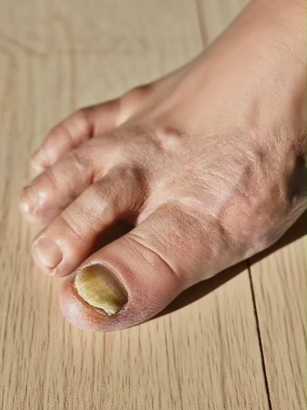 I've finally cured my 3 year-long fungal nail infection!#elaimeifungalnailspatch #fungalnailtreatment #tiktokshopbacktoschool #fungalnail #afforable #nailcare #antifungal #nailcaretips #beforeandafter #tiktokmademebuyit #flashsale #elaimei #toenails #nails💅 #freeshipping #fyp