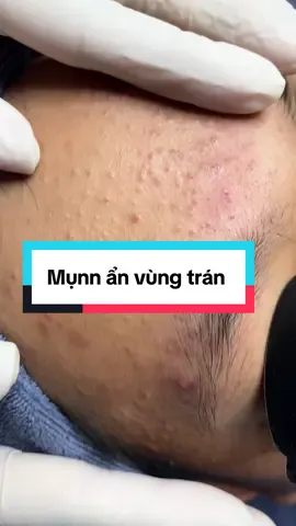 Cải thiện mụnn ẩn như thế nào? 