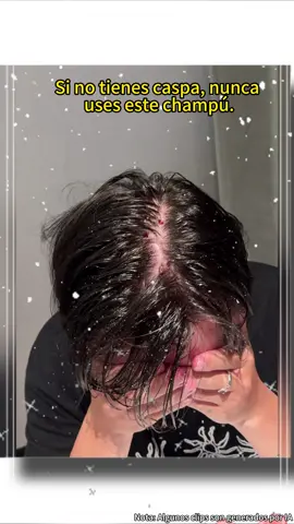 Itchy, oily, flaky scalp? Address all three together.
  #Oilcontrol #itchyscalp #antidandruff #scalpreset #HairCareTips
  