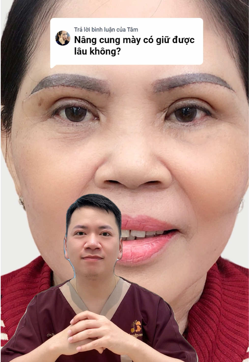 Nâng cung chân mày có phải làm đi làm lại nhiều lần không? #nangchanmay #nangcungchanmay #lamdep #pttm #benhvienthammykangnam 