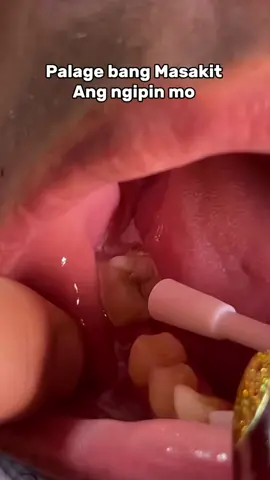 No More sakit naing Ngipin at Hindi na kelangan bunutin pa!!#toothachespray #toothachepainreliever #toothache #swollengums