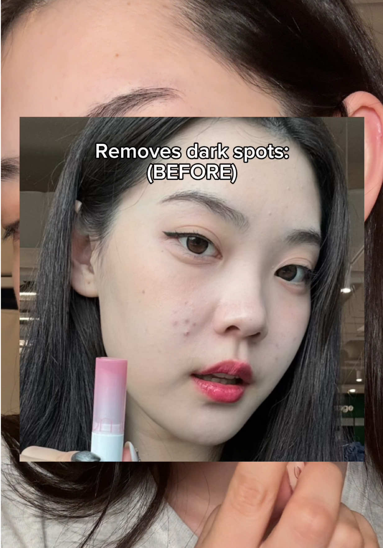 me and my niacinamide till the end of the world💪 #jumiso #niacinamide #hyperpigmentation #acnescars #skicnaretips