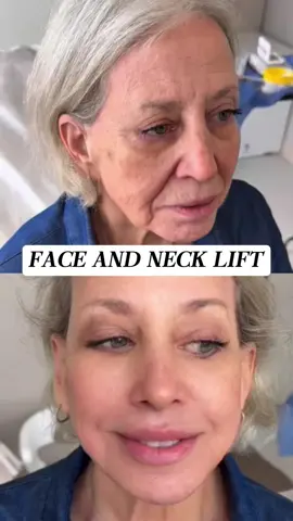 “I’m afraid of looking stiff after surgery.” With the mini-incision SMAS facelift, your expressions stay soft and natural. #facelift #necklift #headlift #MiniFacelift #NaturalPlasticSurgery #subtlerejuvenation 
