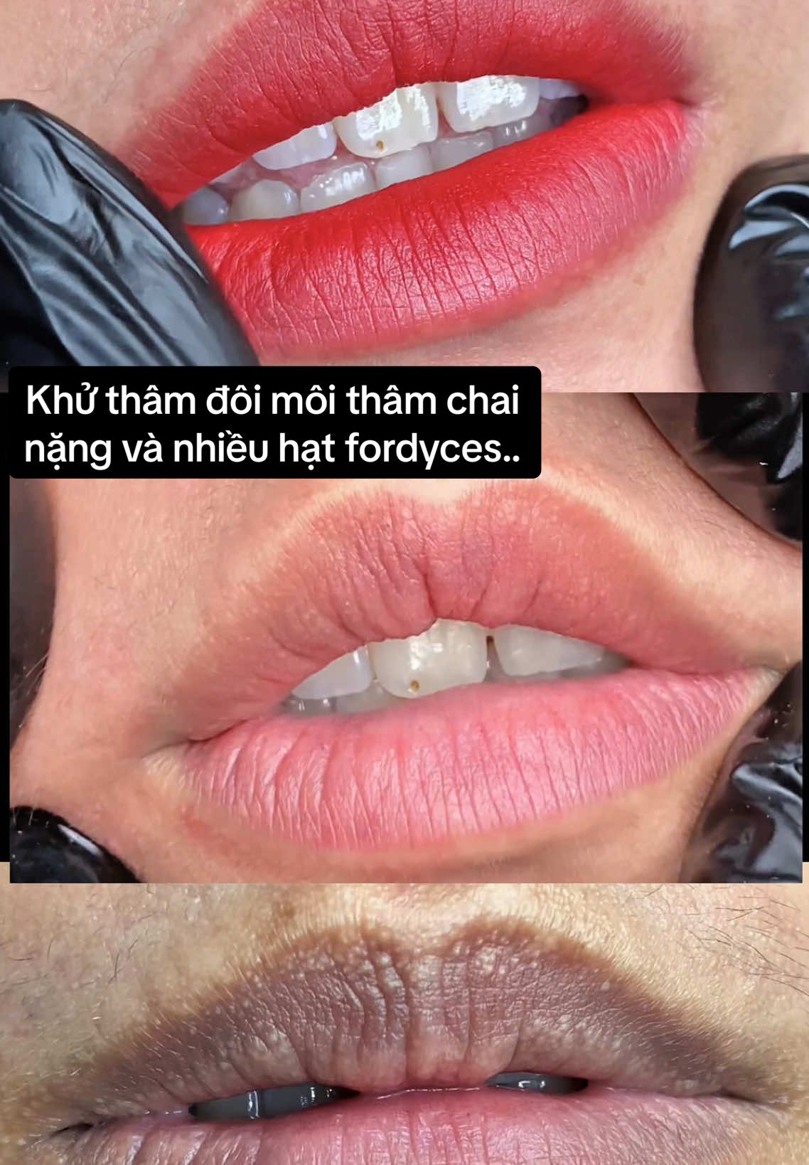 Khử thâm đôi môi thâm chai nặng và nhiều hạt fordyces cho em khách sv năm 3 ĐH Nha Trang 💋 #lamdep #xuhuong #LearnOnTikTok #khuthammoinhatrang  #khuthammoi 