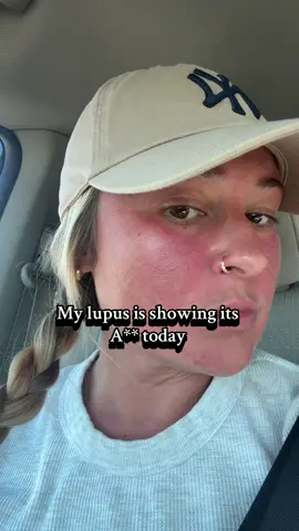 Just driving in the sun for 10 mins today. I think bc I have a cold and we’re getting over a virus that my lupus is flaring. Anyone else? #lupus #flare #autoimmunedisease #lupuswarrior #lupusawareness 💜💜💜