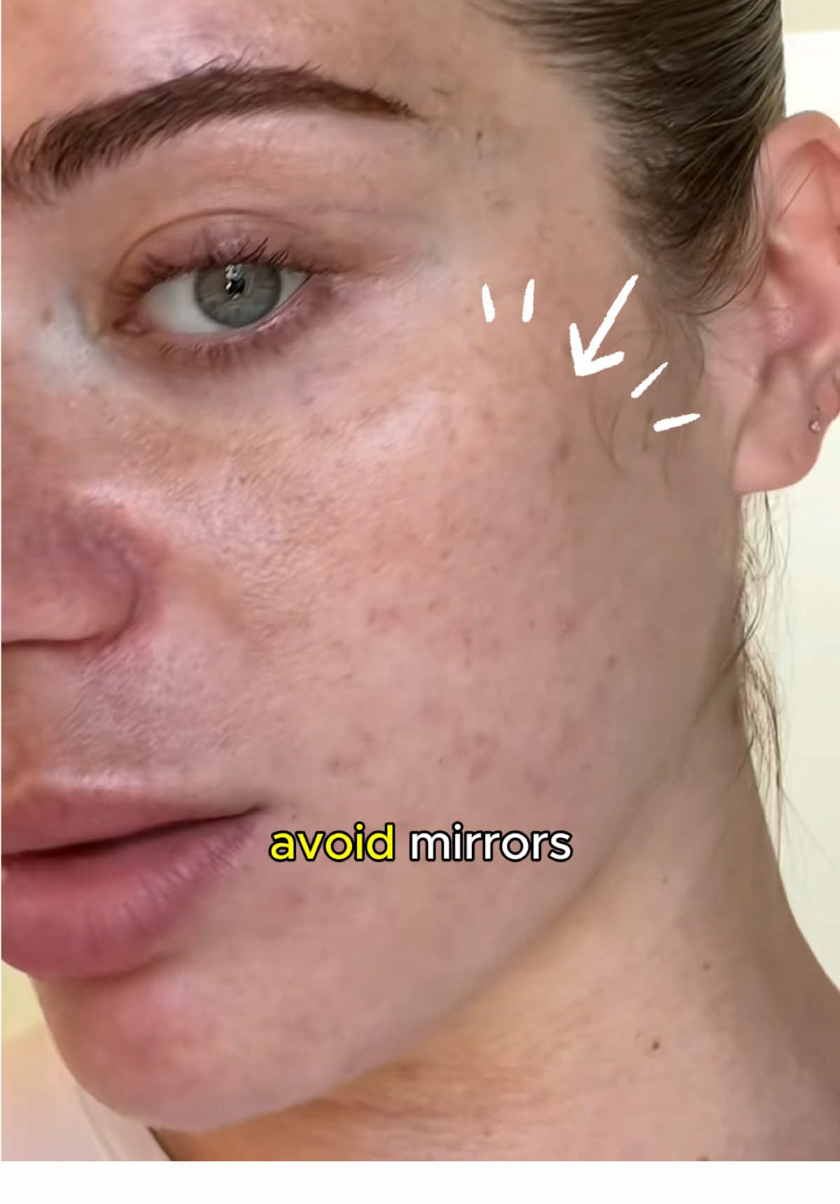 Only 7 days, melasma has faded ✨ #skincareroutine #melasma #fyp #skin #ayanaus 