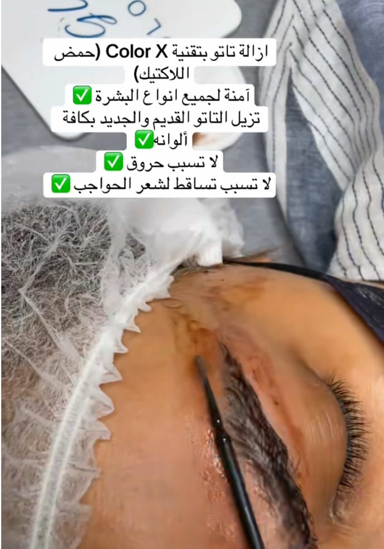 ازالة تاتو الحواجب بأفضل و أحدث التقنيات✅ #ازالة_تاتو #foryou 