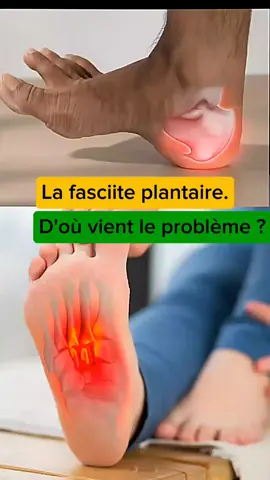 Comment  soulager les douleurs de la fasciite plantaire ? si tu souffre des douleurs de la fasciite plantaire regarde cette vidéo jusqu'à la fin. #fasciteplantaire #fasciiteplantaire #douleurautalon #traitement #symptomes 