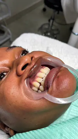 Brighten your smile, boost your confidence! ✨ At Silk Spa, our professional teeth whitening treatment gives you a radiant glow that turns heads. Because a beautiful smile never goes out of style. 😁💎 📍 Visit us in Gwarimpa today and shine brighter than ever! #SilkSpa #TeethWhitening #SparklingSmile #GwarimpaSpa #SelfCareLuxury   