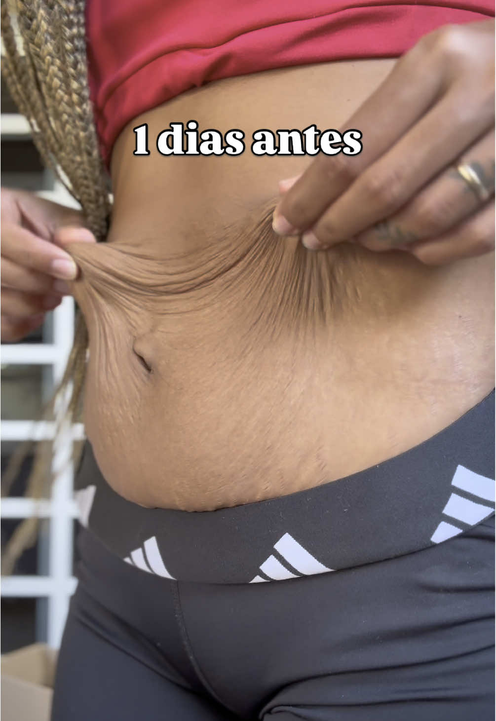#abdominoplastia #diastase #flacidez #estrias #antesedepois #maternidade #viraltiktok 