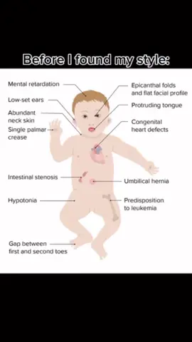 #fyp #viral #trisomy21 #theluckyfew💛💙 #girlmom  we are so lucky 🍀 