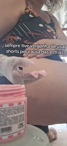 aa estrias sempre me incomodaram mas depois desse creme minha auto estima ta voltando #estriasbrancas #antesedepois #estrias #transformação 