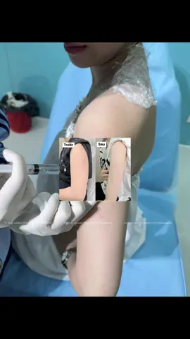 📌 𝐁𝐎𝐓𝐎𝐗 𝐓𝐇𝐎𝐍 𝐆𝐎̣𝐍 𝐁𝐀̆́𝐏 𝐓𝐀𝐘📌 -giải pháp cứu cánh cho các nàng có bắp tay to , thô tự ti khi mặc áo cộc tay #KTAnnyAcademy #shihanukville #mocbaibavet #trending #hot   