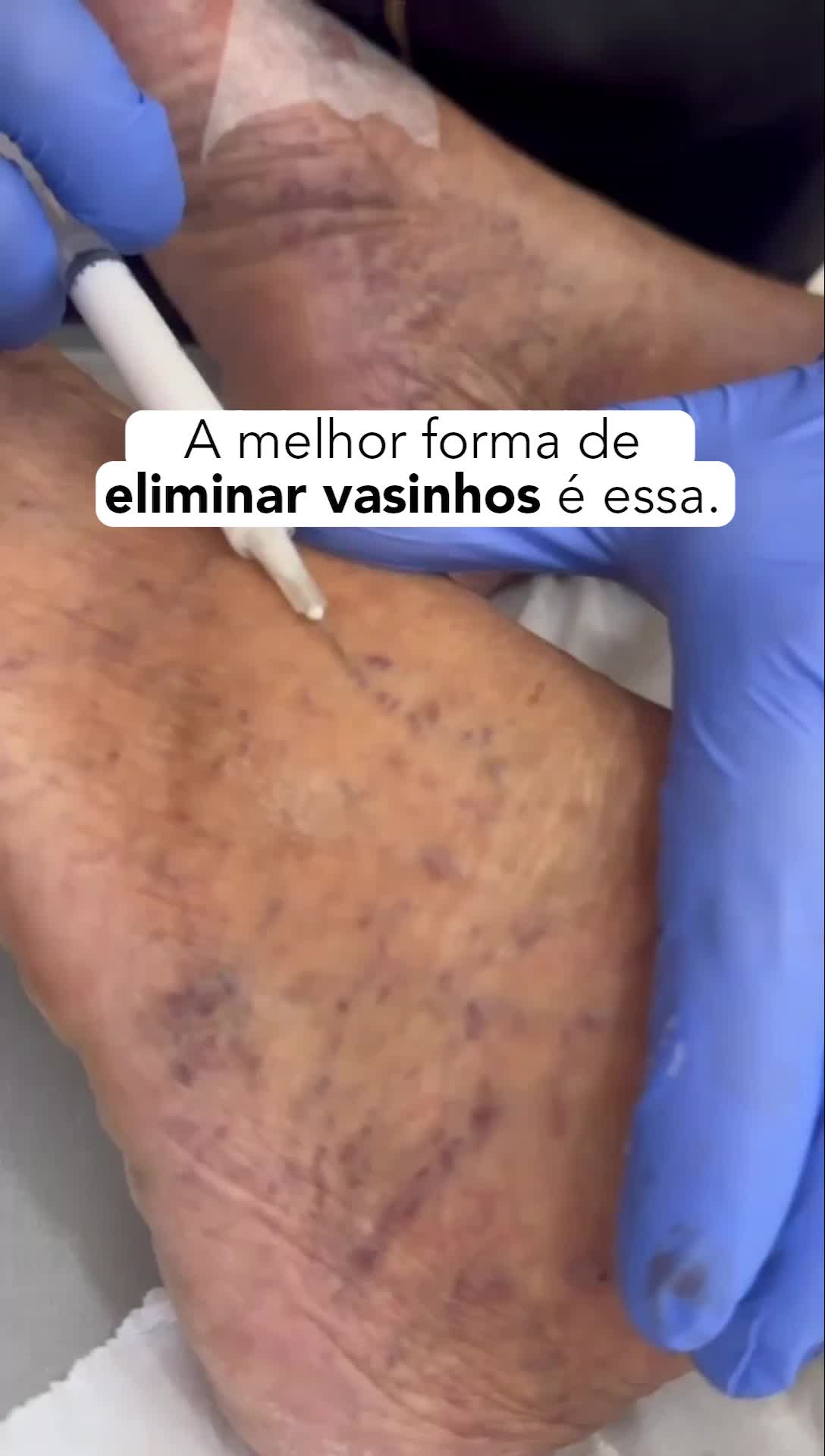 Você sabia que os vasinhos, além de serem indesejáveis esteticamente, podem indicar problemas circulatórios? Mas não se preocupe, a boa notícia é que existem tratamentos super modernos e eficazes para eliminá-los de forma segura e rápida! Nosso consultório está sempre atualizado com as técnicas mais avançadas, garantindo resultados incríveis e a satisfação dos nossos pacientes. Imagine se livrar desses vasinhos e exibir suas pernas com confiança! Se você ou alguém que você conhece está lidando com esse problema, marque aqui nos comentários. #varizes #vasinhos #tratamentoparavarizes #drluizeas