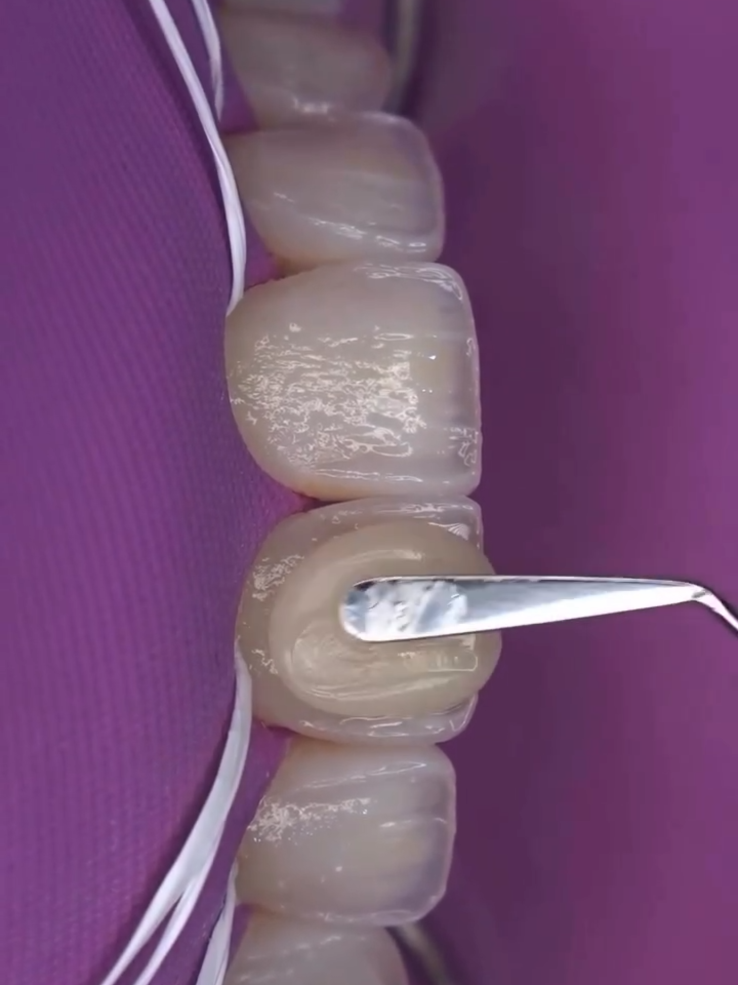 Elóra APS é a resina composta que proporciona excelente manuseio e resultados surpreendentes para as diversas restaurações do dia a dia clínico. ​ ​ Seu sistema de cores proporciona simplificação e previsibilidade aos procedimentos restauradores. Ela conta com opções de cores massa para corpo (body) , três opções de dentina e 2 efeitos esmalte translúcido oferecendo resultados estéticos com naturalidade. ​ #odontologia #odontologiaestetica #fgmodonto ​