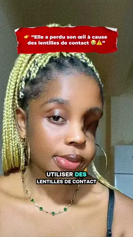 #HistoireVraie #SantéDesYeux #AttentionLentilles #PréventionSanté 