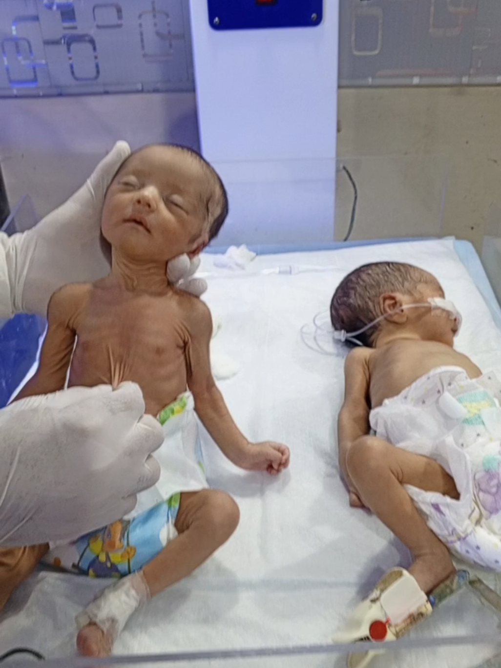 Premature Baby skinny perblom ♥️🥺 #feedingtime #baby #viral #babycare #premuturebaby 