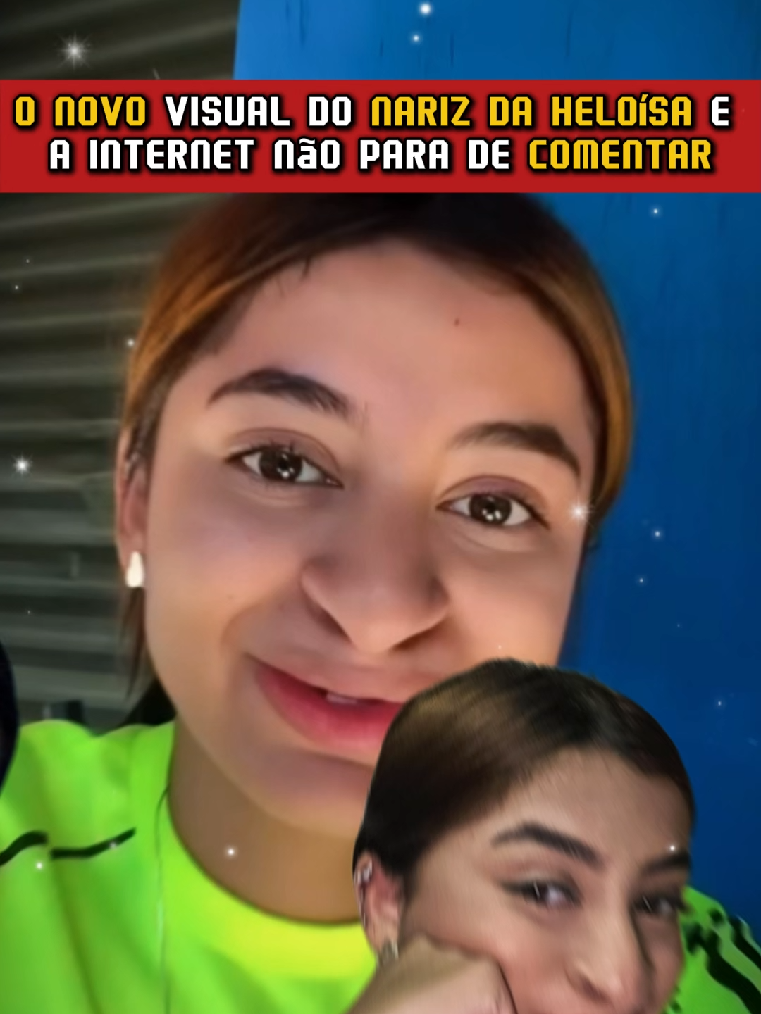 Heloisa Posta Resultado Da Rinoplastia #heloisa