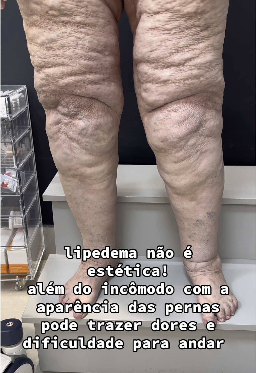 #lipedema 